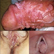 Illustration for article titled Obat Penghilang Kutil Kelamin